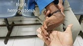Lance Adams Syndrome Post Hypoxic Myoclonus Youtube