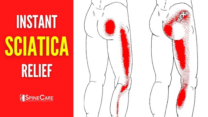 5 Ways To Quickly Relieve Sciatica Pain With 3 Simple 2024