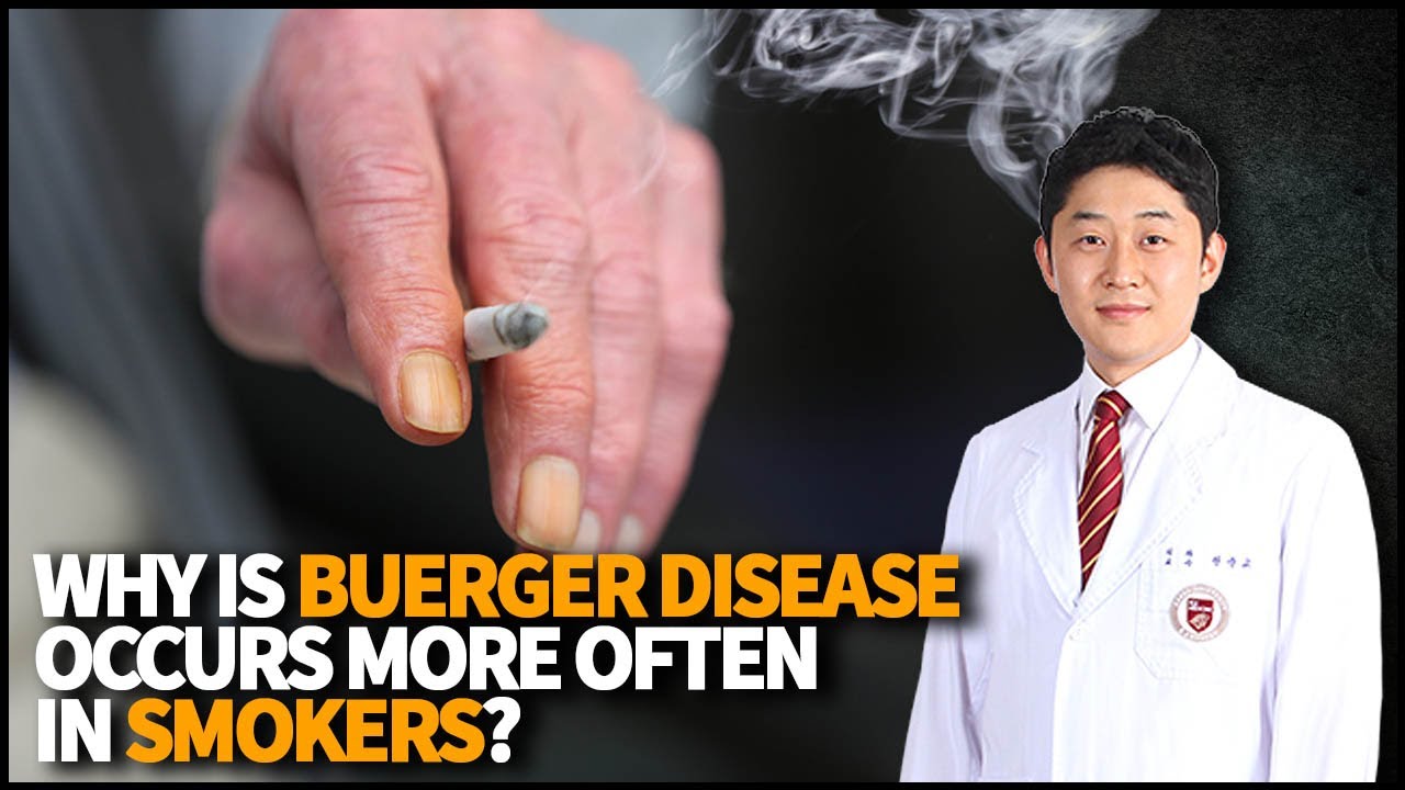 Why is Buerger Disease occurs more often in smokers than nonsmokers