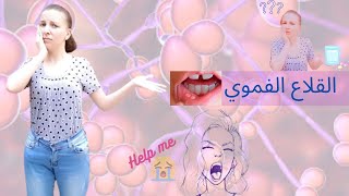 القلاع الفموي | أسبابه و علاجه