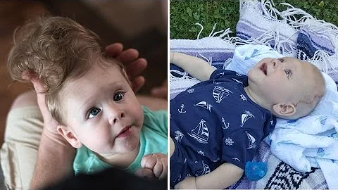 Baby Born with Brain Outside of Skull Gets Life-Changing Surgery - DayDayNews