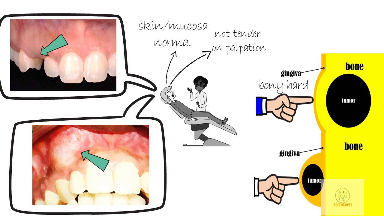 Adenomatoid odontogenic tumor
