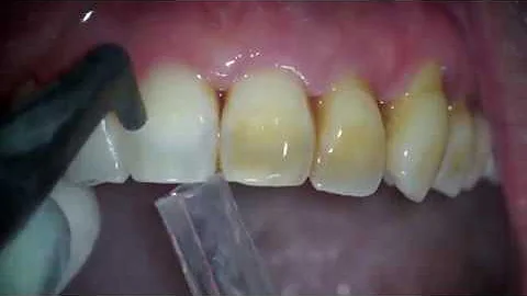 Removal of biofilm, stains and young calculus - Dr...