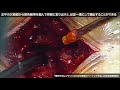 動画4　腰部脊柱狭窄症に対する腰椎椎弓切除術