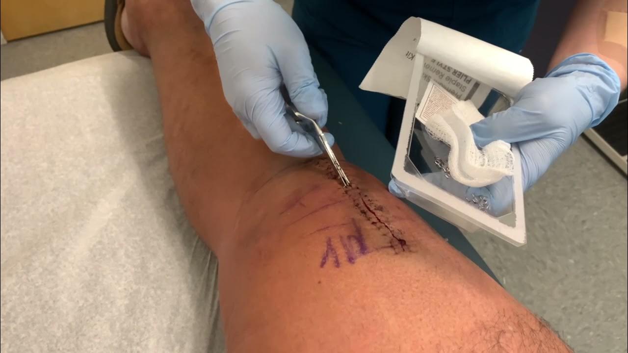 Staples removed after knee surgery YouTube