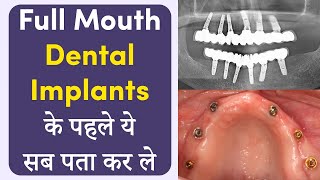 Full Mouth फिक्स बत्तीसी के पहले आपको ये जानना जरूरी | fix Teeth in Indore | Dr. Ankit | Seraphic by SERAPHIC DENTAL CLINIC INDORE 2,037 views 2 months ago 11 minutes, 27 seconds