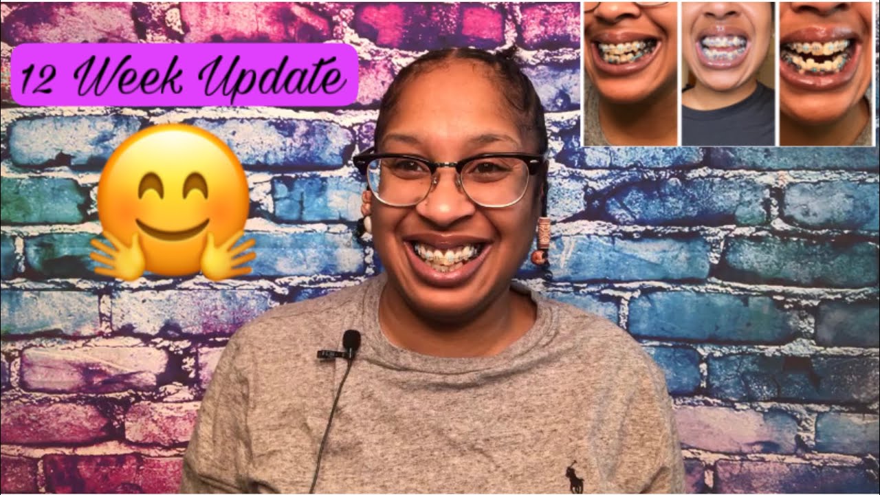 ADULT BRACES VLOG 12 WEEK UPDATE ORTHODONTIST APPOINTMENTBRACES WIRE