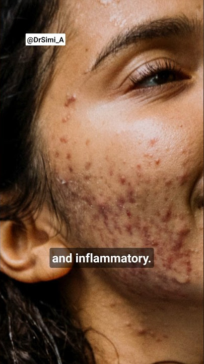 2 Types of Acne | Inflammatory Acne vs Noninflammatory Acne