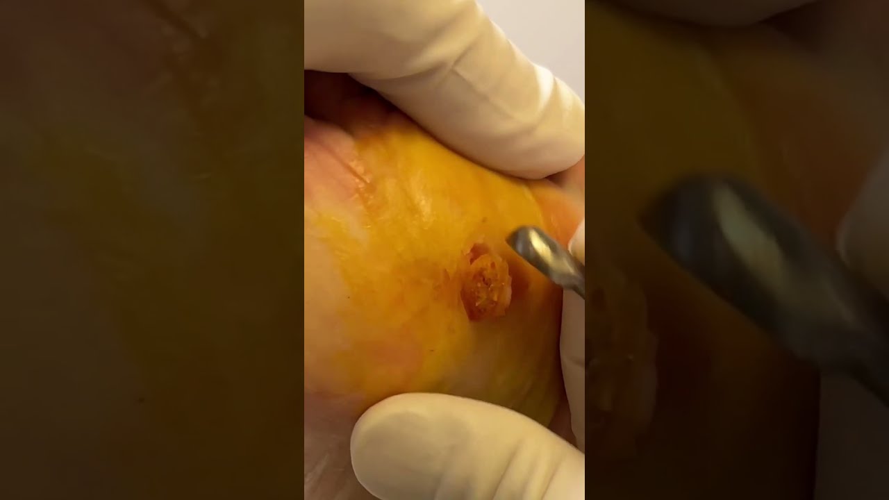 Watch This Plantar Wart Removal Surgery A Satisfying Procedure For Foot Enthusiasts 