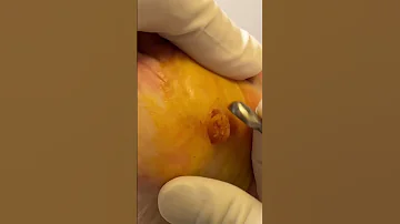 Watch This Plantar Wart Removal Surgery A Satisfying Procedure For Foot Enthusiasts 