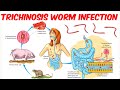 Trichinosis (Trichinellosis) Worm Infection
