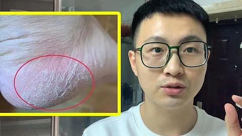 【皮肤科医生】一招摆脱脚后跟干裂 - 天天要闻