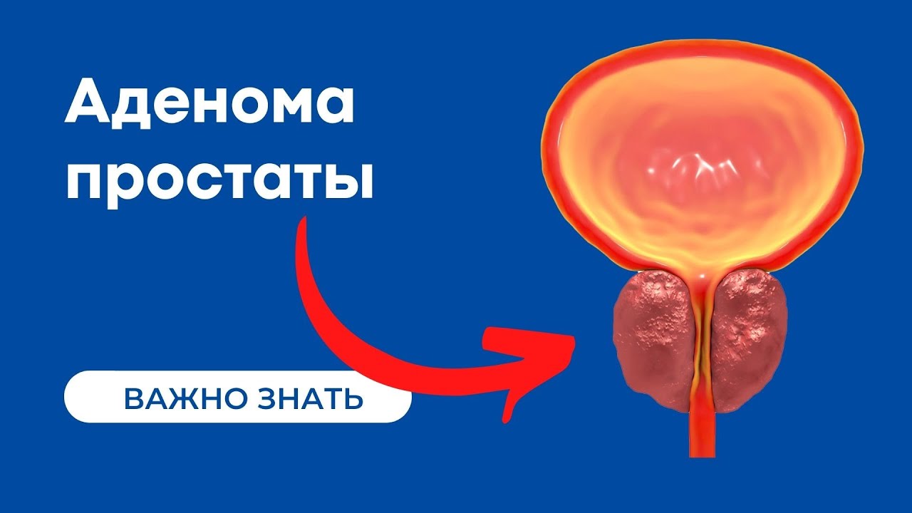 Аденома простаты | Гиперплазия предстательной железы - YouTube