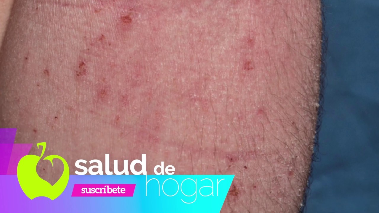 7 Útiles Consejos para Curar el Eczema YouTube