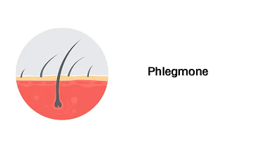 Wie lange dauert die Heilung einer Phlegmone?