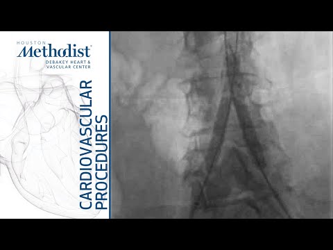Kissing-Stenting Technique for Aorta-Iliac Lesions (Maham Rahimi, MD, PhD, Tarundeep Singh, MD)