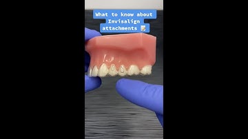 Invisalign Attachments Explained!