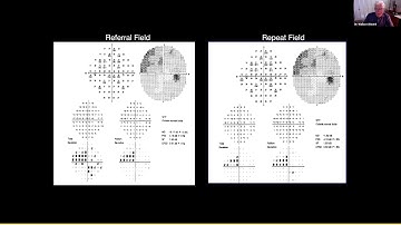 Lecture: Advanced Perimetry Interpretation: Recognizing and Dealing With Artifacts