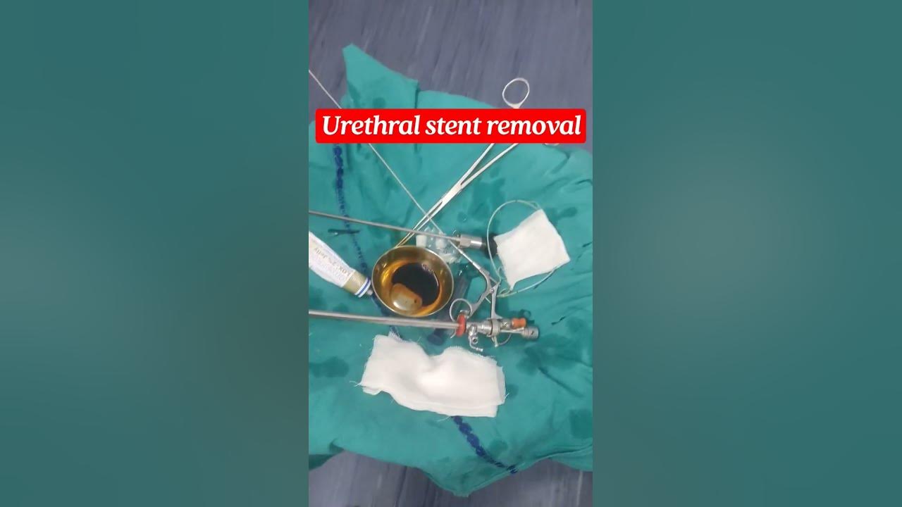Urethral stent removal cystoscopy and stent removal medical aiims