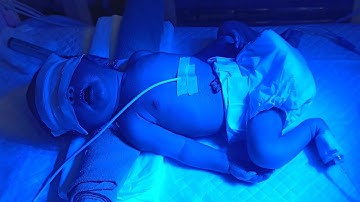 New born cute baby jaundice treatment on photography lights in nicu 🚼👨‍⚕️🏥