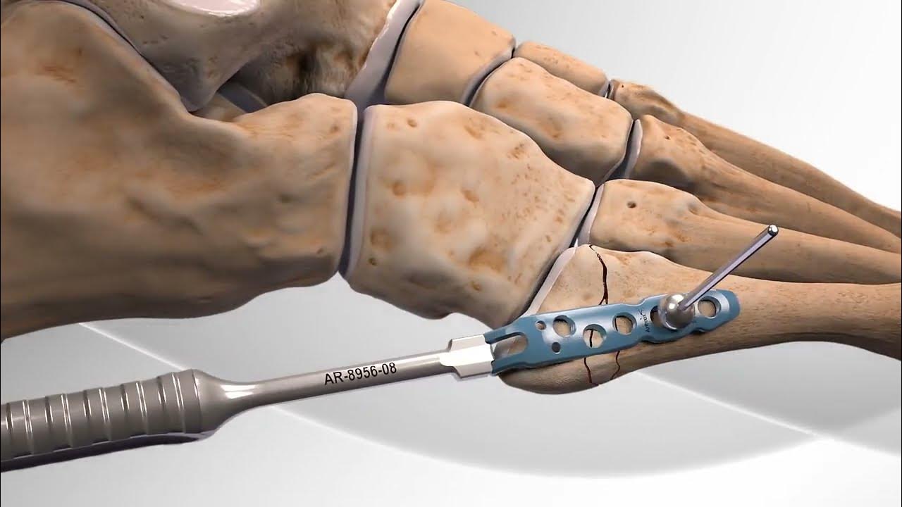 Fracture 5e métatarsien (Jones) Chirurgie fixation ostéosynthèse par plaque Dr Simon