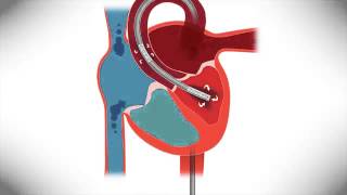 TandemHeart Support with Confidence