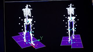 Mayo Clinic Minute: Using gait to help in early diagnosis of neurodegenerative disease