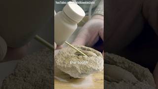 Fossilized Tooth Extraction                 #shorts