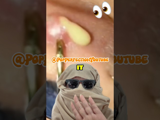 Explosive pops! 😍 #blackheads #youtubeshorts #pimples  #oddlysatisfying #acne #pimplepopping