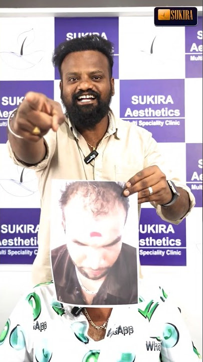 👴 வழுக்கை தலை பெரிய மேட்டரே கிடையாது ❌ | Tamil Hair Transplant #coimbatore #shorts
