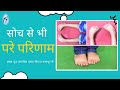 Excellent Results in B/L club Foot (CTEV) with plaster & brace