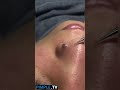 Extracting large blackheads big cystic acne blackheadswhiteheads removal pimple popping 143 short