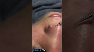 Extracting Large Blackheads Big Cystic Acne Blackheads&Whiteheads Removal Pimple Popping #143 #Short 