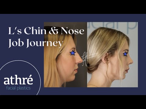 Patient L's Chin Augmentation + Nose Job (Ultrasonic Rhinoplasty) BEFORE & AFTER Photos