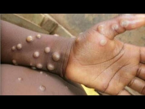 Health segment: All you need to know about Monkey Virus and Marburg Virus | Breakfast Daily