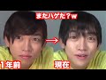 【ハゲ日記】AGA薄毛治療77ヶ月目！