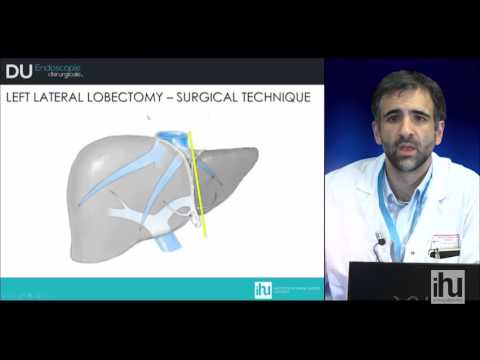 Video: A dhemb hepatektomia?