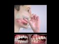 Baby Thumbs sucking effect on teeth and Jaws
