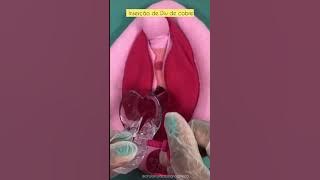 Como é feita a colocação do DIU ?