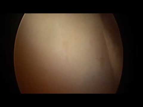 Saving Hip joint with Hip Arthroscopic surgery, femoral osteoplasty