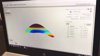 Using the sMap3D scleral topography to help design lenses for keratoconus patients