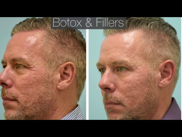 Dallas Botox and Fillers Before and After