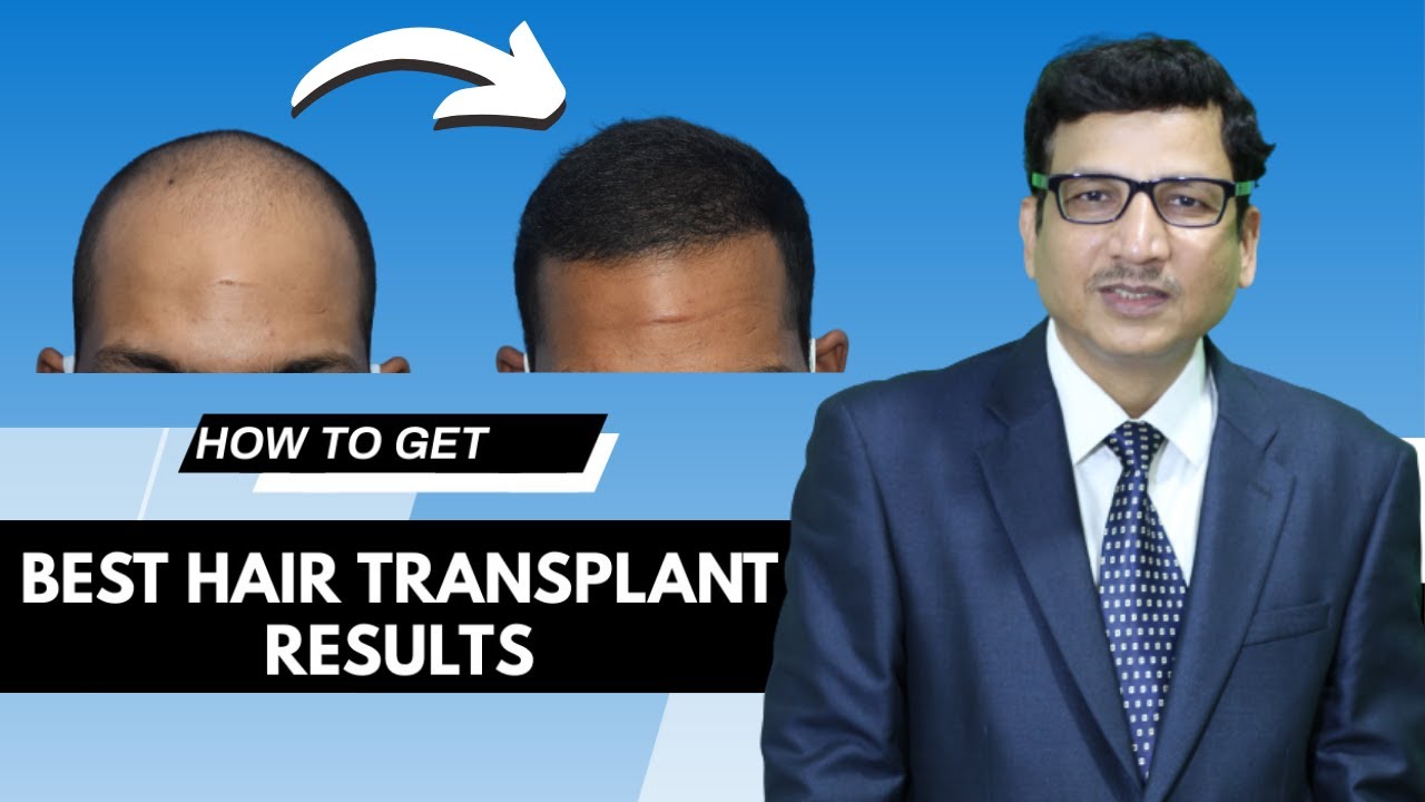 Hair Transplant Before And After Results  The Venkat Center