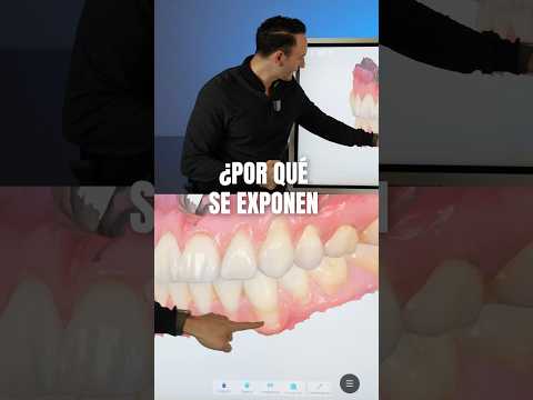 El cepillado NO le retrajo así su encía.