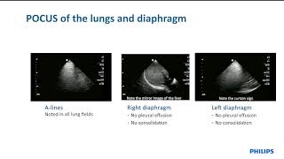 Philips Lumify case study:  An opportunity to potentially reverse a cardiomyopathy