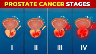 Silent Prostate Killer: Are You at Stage X Without Even Knowing?