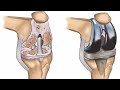 Preoperative clinical picture of both knee osteoarthritis
