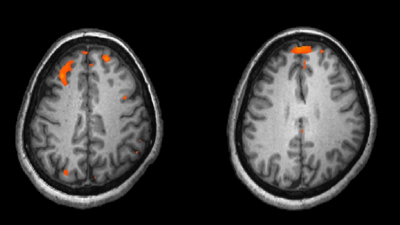 Как распознать шизофрению. Особенности психических заболеваний Урале ...