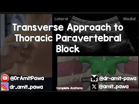Image of Transverse Approach to the Paravertebral Block