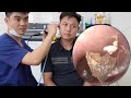 💫耳かき | 耳掃除 | 患者が偶然医師に出会った 💖 DR. LAI MINH TUAN